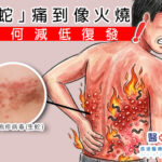 「生蛇」痛到像火燒,如何減低復發 !