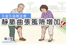 久坐久站族注意!靜脈曲張風險增加